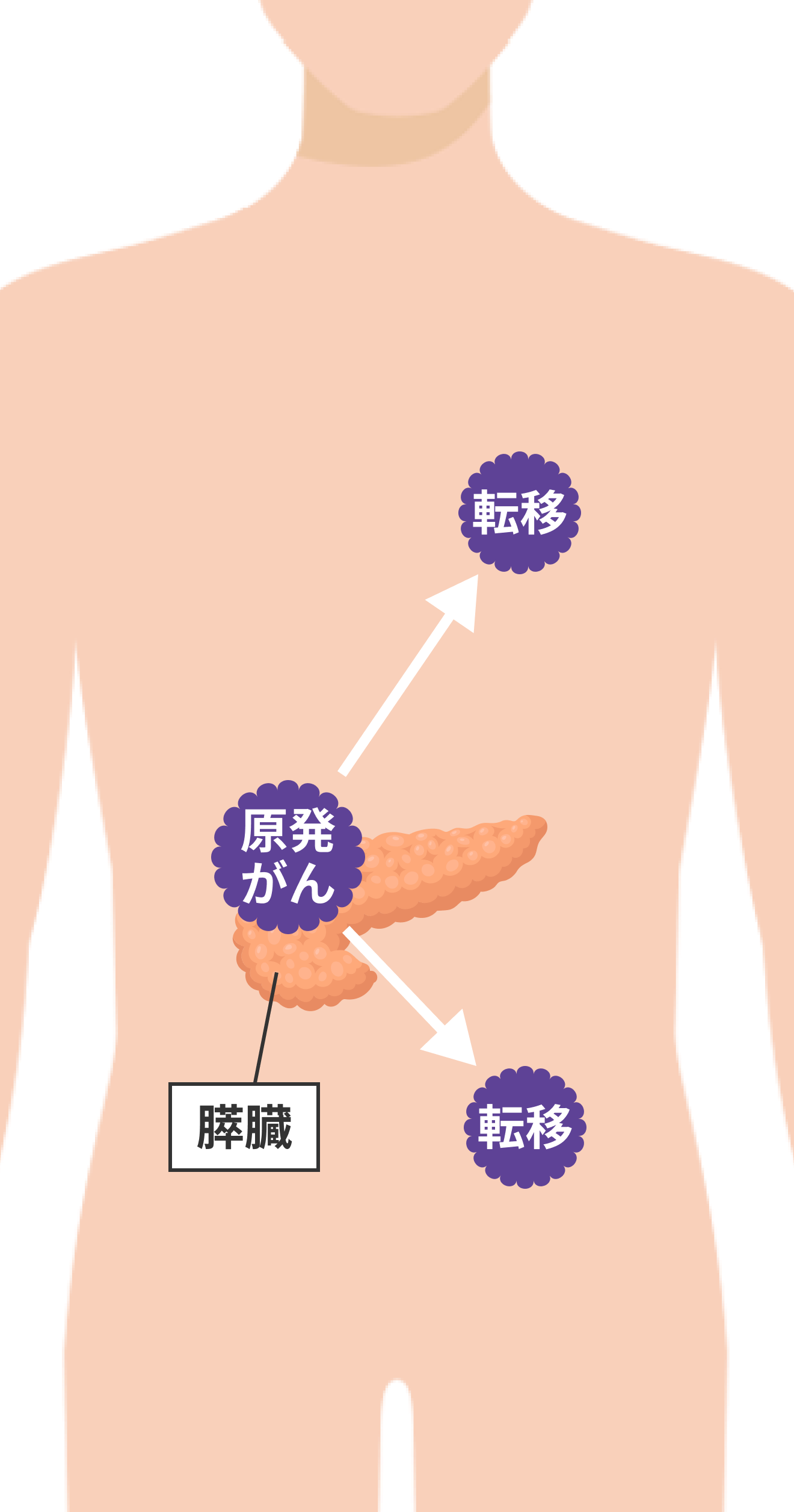 膵臓がんだけでなく他の臓器に転移した状態