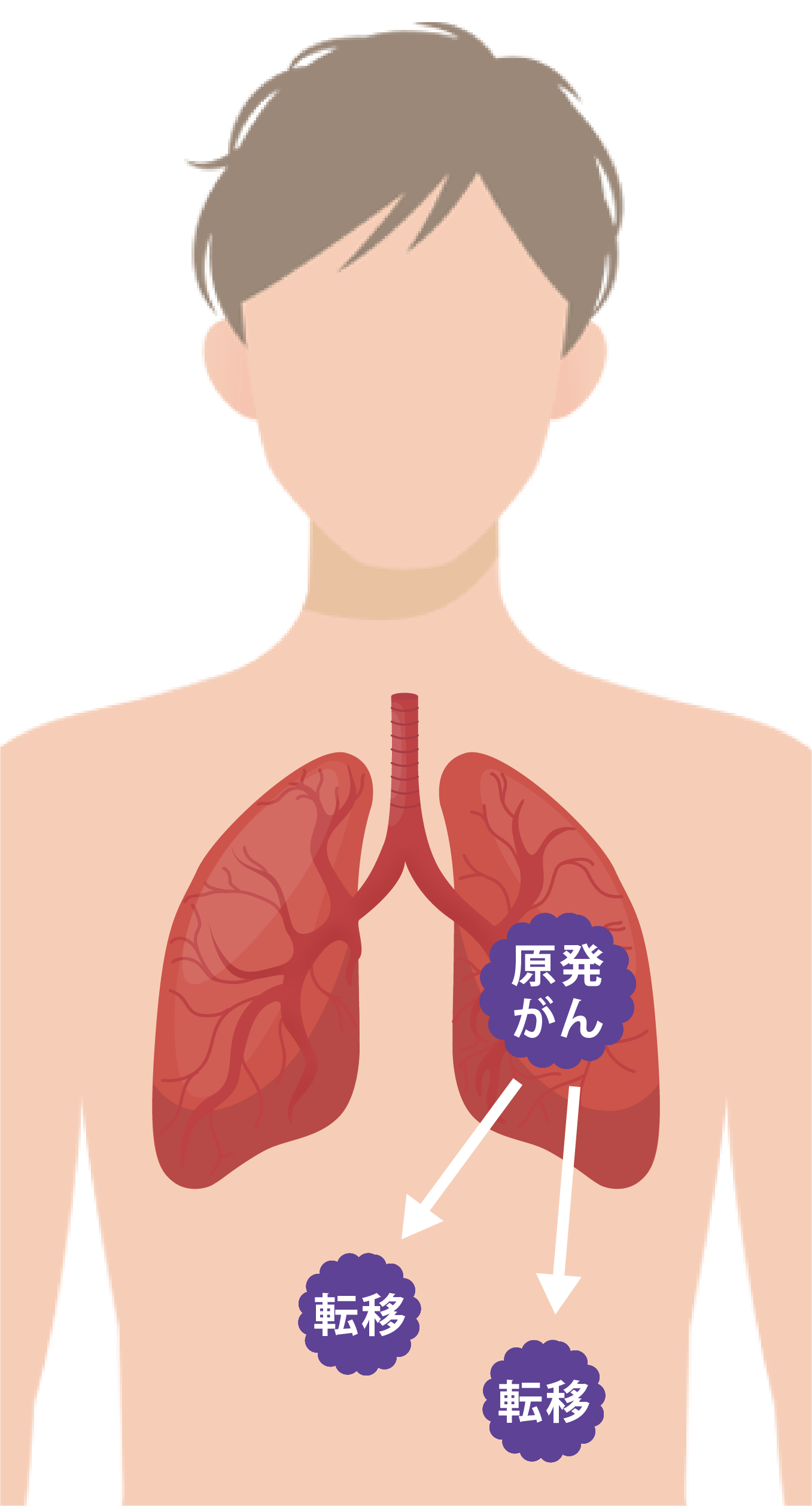 原発の肺だけでなく他の臓器に転移した状態