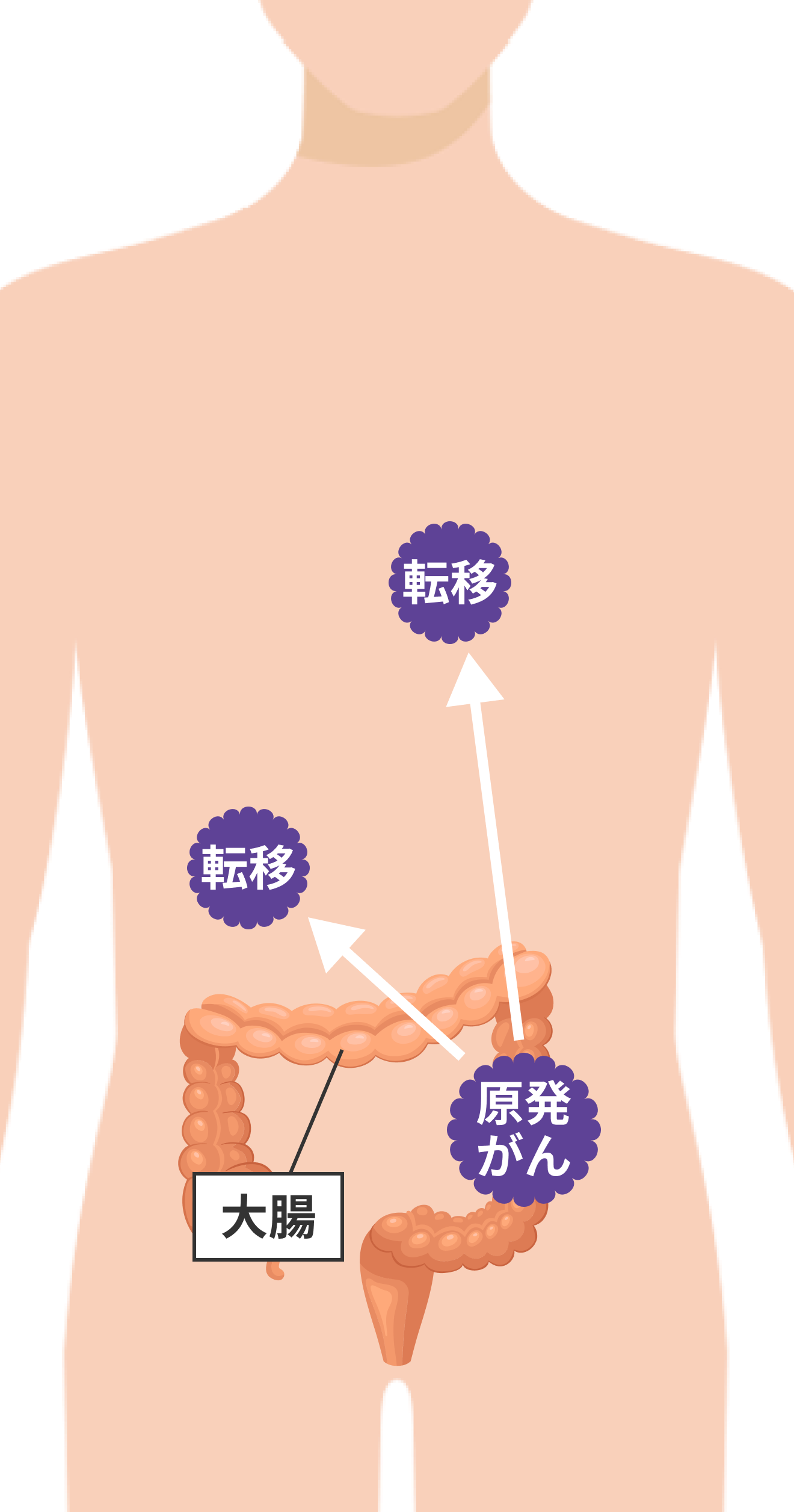 大腸がんだけでなく他の臓器に転移した状態