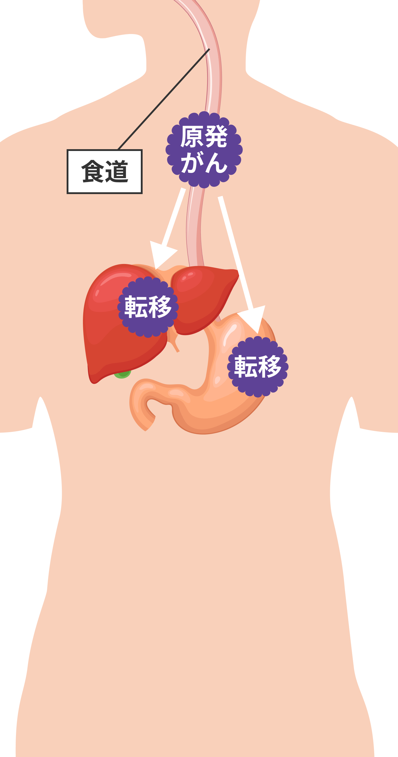 食道がんだけでなく他の臓器に転移した状態