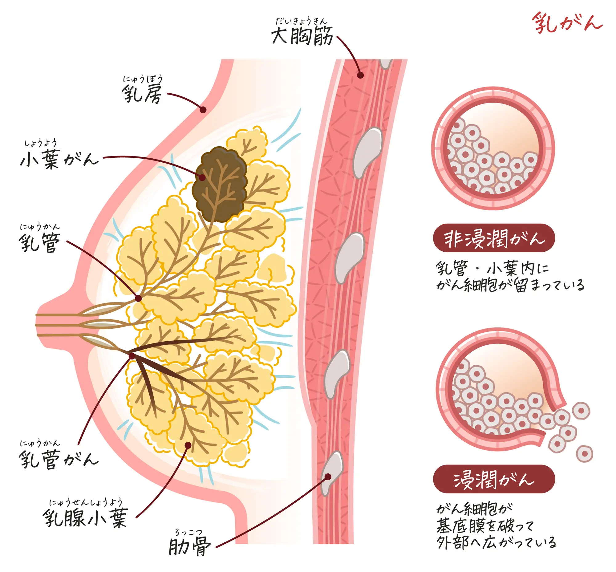 浸潤 性 小葉 が ん