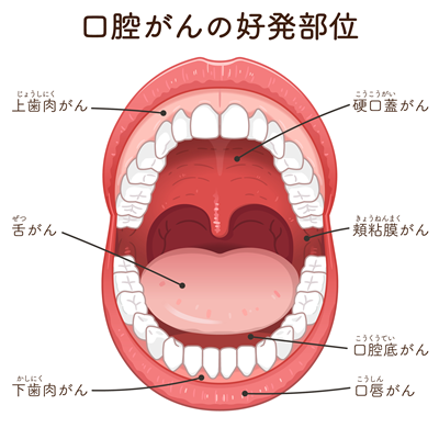 口腔がんの発生した部位ごとの名称の違い